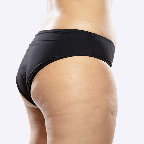 Inestetismi da cellulite